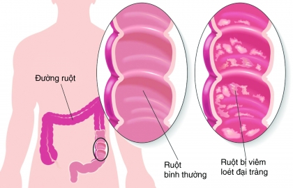 Chữa bệnh viêm đại tràng bằng cây thảo dược tự nhiên an toàn và không lo chi phí